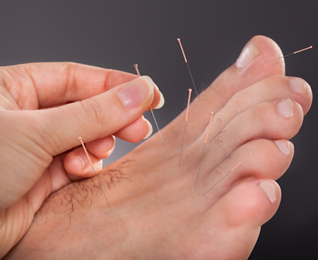 acupuncture