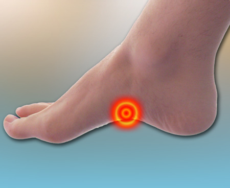 high-arches-as-foot-pain